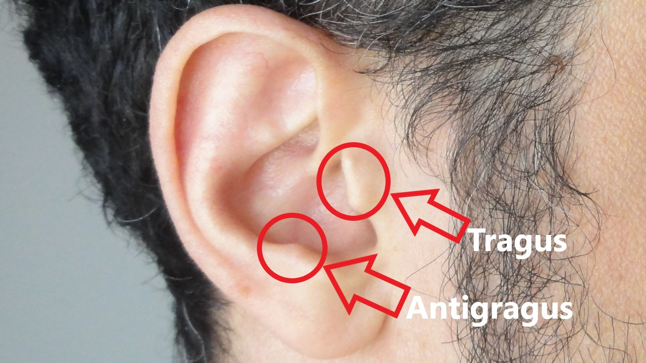 Tragus and antitragus of the auricle.